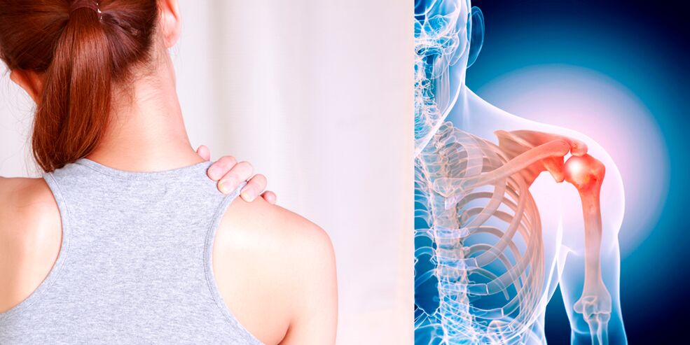 Развитие остеоартроза плечевого сустава постепенно приводит к стойкой боли. 