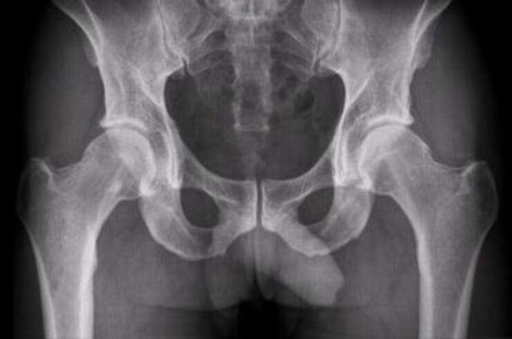 Боль на рентгене тазобедренного сустава